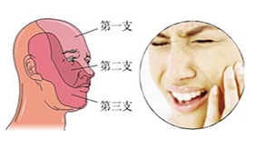 三叉神经痛的治疗方法有哪些？