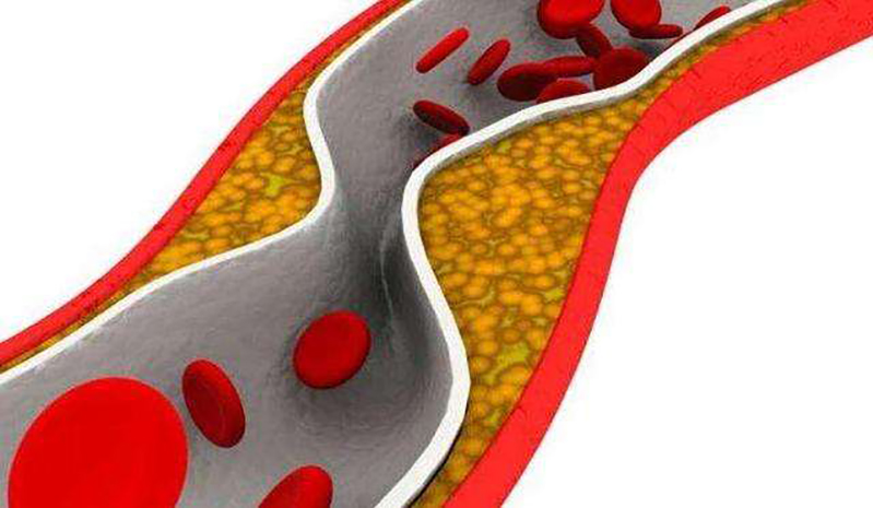 通过运动能降低甘油三酯吗？