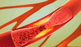 心梗脑梗都与动脉硬化有关，如何预防血管硬化？