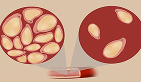 甘油三酯是什么，正常值是多少？水平过高，该如何降下来？