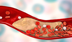 软化血管的4大常见误区你了解几个？保护血管健康，不妨做好5点