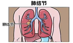 新冠康复体检安排了吗？查出肺结节怎么办？