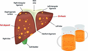 哪些人容易患上脂肪肝？