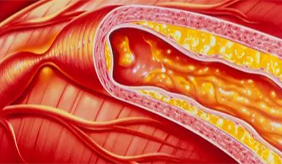 6种症状提醒你该查血脂了！控血脂饮食指南来了