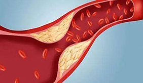 血脂异常不吃油就可以了？控脂饮食可没这么简单