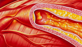 高血脂、高血压、糖尿病人群饮食指南来了