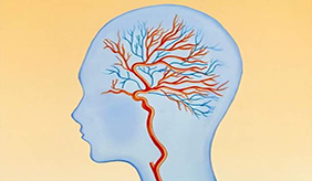 脑血管病为何“偏爱”早晨发作