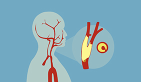 哪些人群需要做颈动脉超声检查?