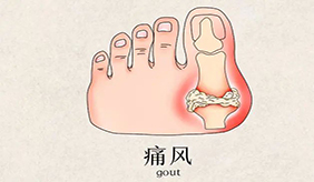 痛风对健康的影响到底有多大？