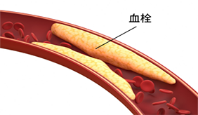 血栓，守护生命的“河流” 