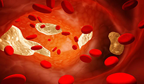 关于血脂的四个误区。