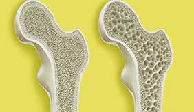 骨质疏松症盯上中青年的原因有哪些?如何预防骨质疏松?