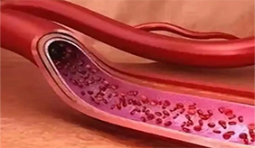 耳鸣有这5个特点，可能是脑血管病 