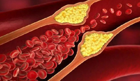 血脂晴雨表一次体检读懂身体信号